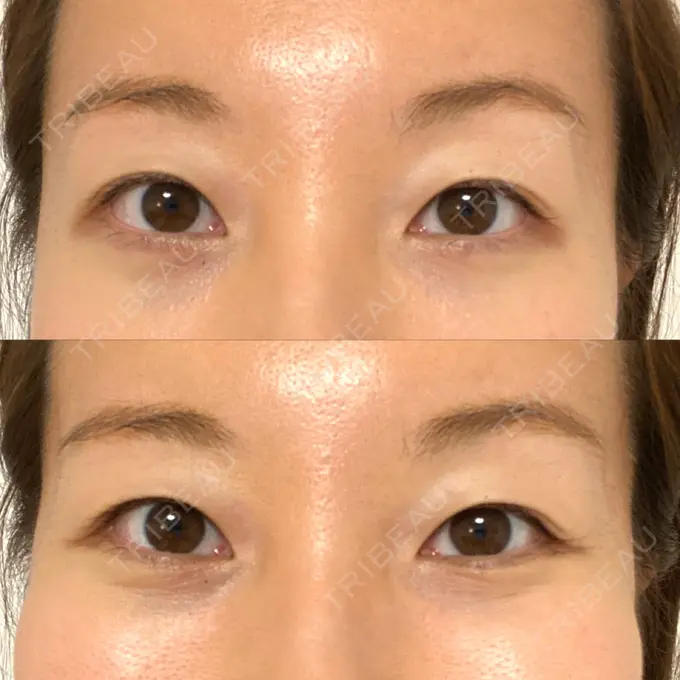 クマ治療 X CLINIC 恵比寿院 DAY 18 メイン用