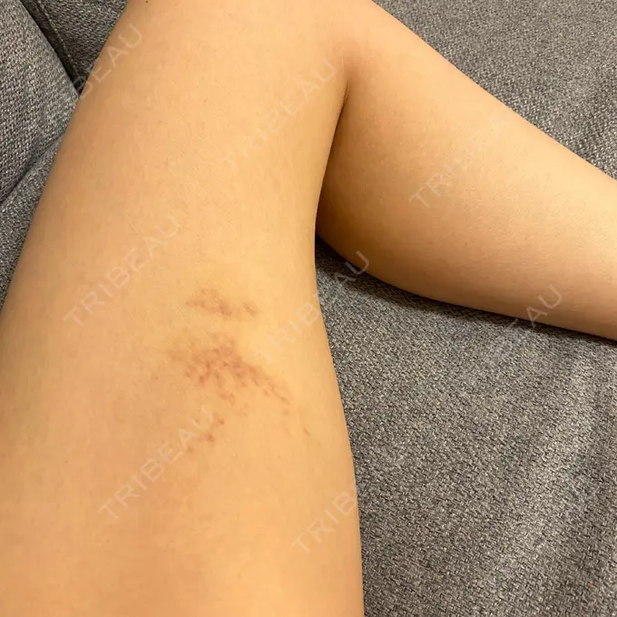 クマ治療 X CLINIC 恵比寿院 DAY 18 メイン用