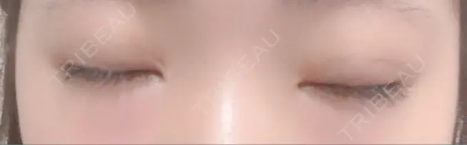 二重埋没 十仁美容整形 DAY 31 メイン用