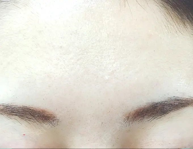 その他（目元） 東京美容外科 秋田院 AFTER メイン用