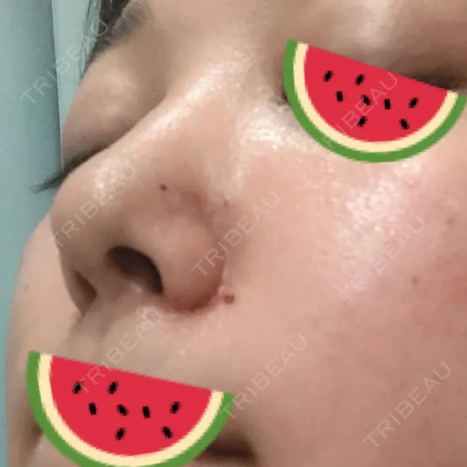 鼻尖形成（切開） / 小鼻縮小（切開） みずほクリニック DAY 11 メイン用