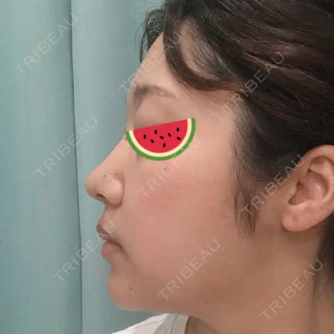 鼻尖形成（切開） / 小鼻縮小（切開） みずほクリニック DAY 11 メイン用