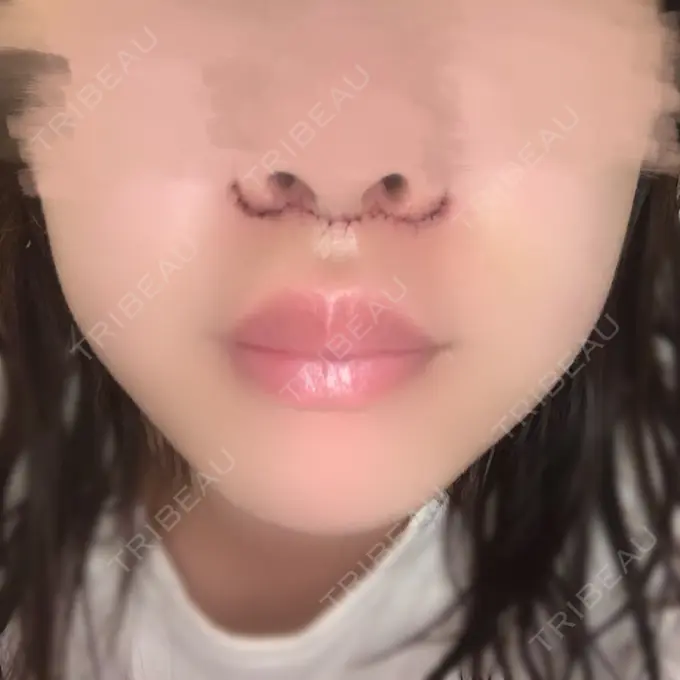 人中短縮 / PRP皮膚再生療法 BIANCA銀座 DAY 2 メイン用