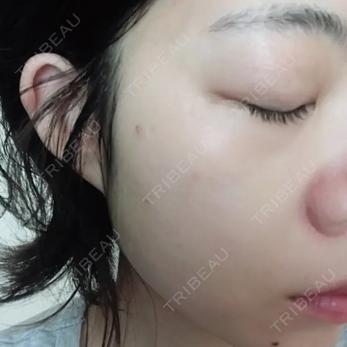 ピーリング（ニキビ・毛穴） / エレクトロポレーション / 光治療（フォトフェイシャルなど） 共立美容外科 仙台院 DAY 6 メイン用