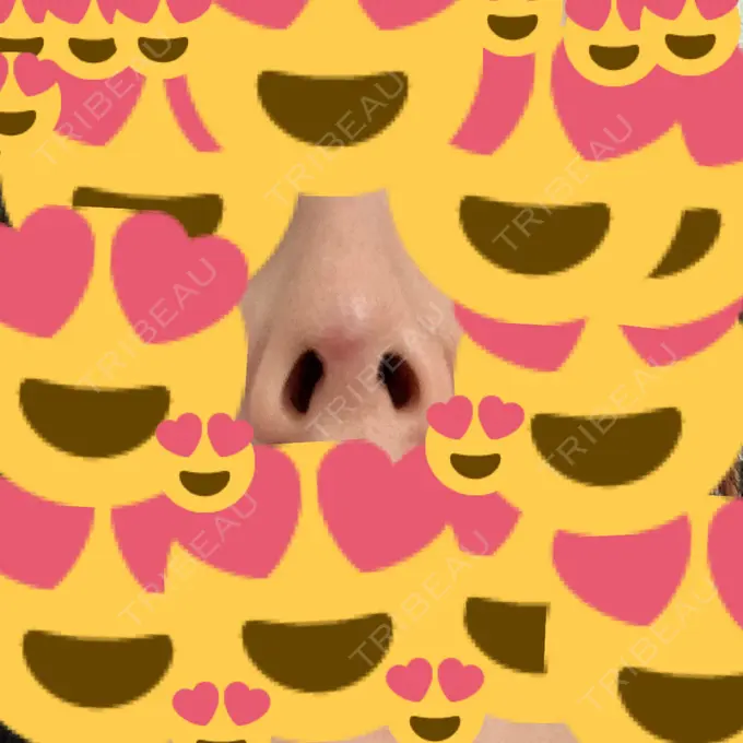 隆鼻術 / プロテーゼ除去 / 鼻修正 十仁美容整形 DAY 6 メイン用