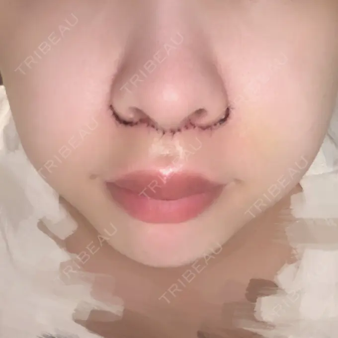 人中短縮 / PRP皮膚再生療法 BIANCA銀座 DAY 3 メイン用