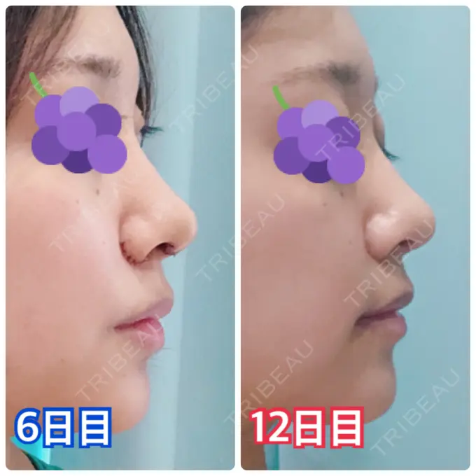 鼻尖形成（切開） / 小鼻縮小（切開） みずほクリニック DAY 12 メイン用