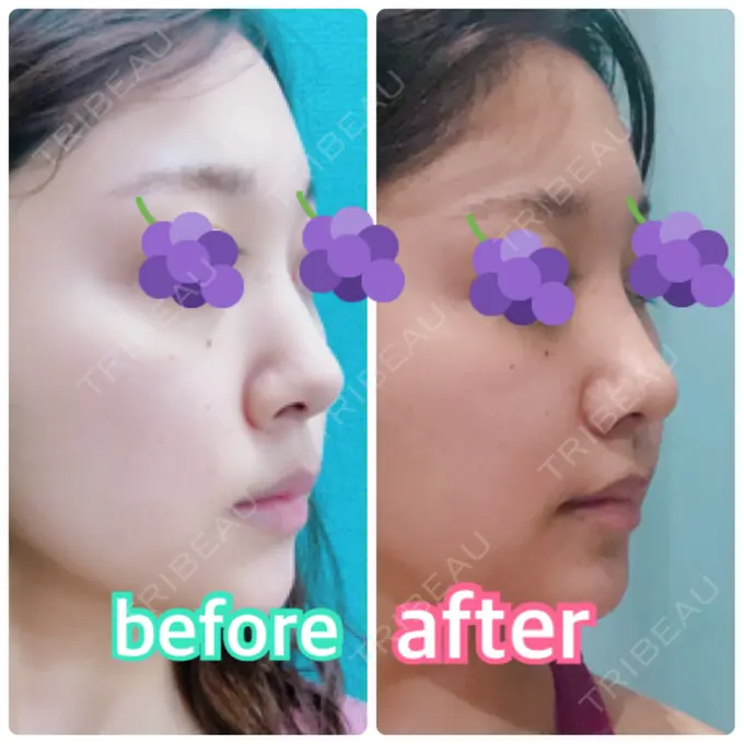 鼻尖形成（切開） / 小鼻縮小（切開） みずほクリニック DAY 12 メイン用