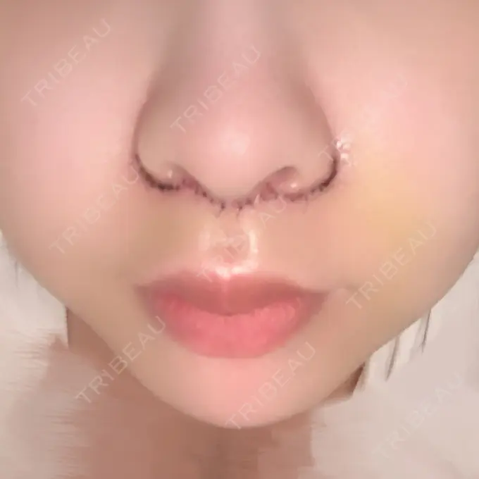 人中短縮 / PRP皮膚再生療法 BIANCA銀座 DAY 4 メイン用