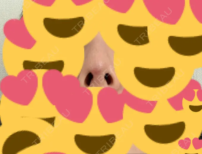 隆鼻術 / プロテーゼ除去 / 鼻修正 十仁美容整形 AFTER メイン用