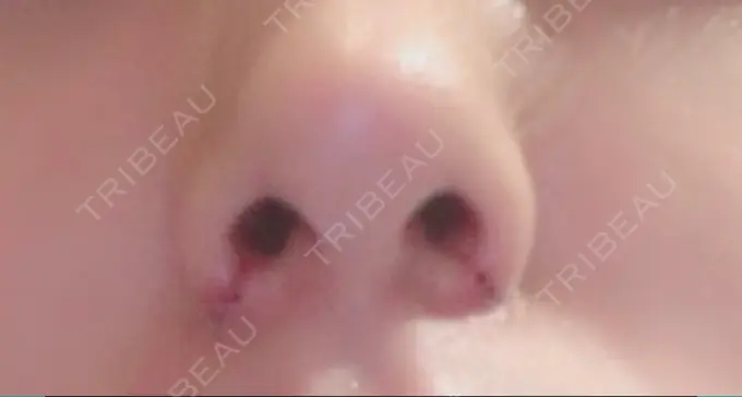 小鼻縮小（切開） TCB東京中央美容外科 渋谷西口院 DAY 5 メイン用