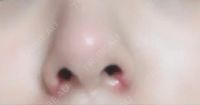 小鼻縮小（切開） TCB東京中央美容外科 渋谷西口院 AFTER メイン用