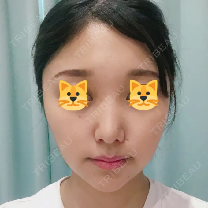 鼻尖形成（切開） / 小鼻縮小（切開） みずほクリニック AFTER メイン用