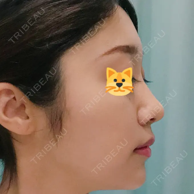 鼻尖形成（切開） / 小鼻縮小（切開） みずほクリニック DAY 13 メイン用