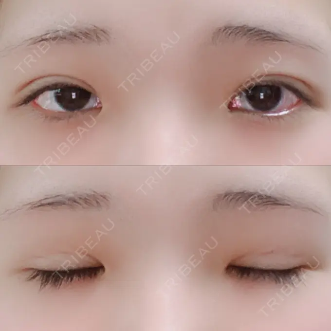 二重埋没 湘南美容クリニック 赤坂見附院 DAY 14 メイン用