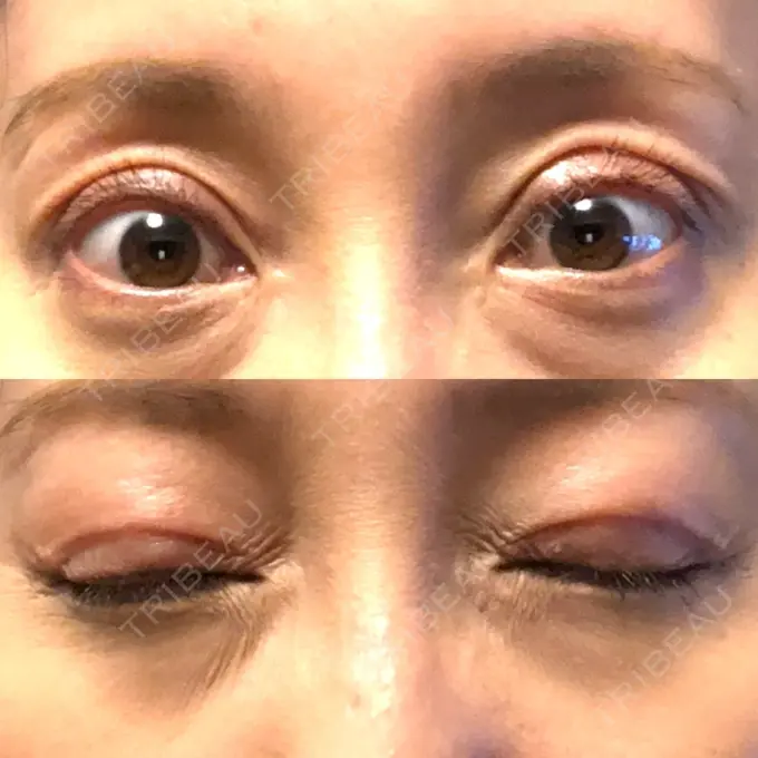 眼瞼下垂（切開） ティーズクリニック DAY 26 メイン用