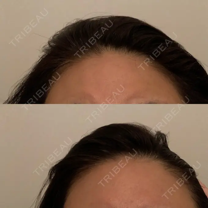 額を丸く / シワ取りボトックス 銀座3丁目・BANNAI美容クリニック DAY 13 メイン用