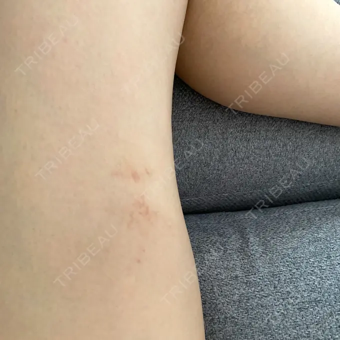 クマ治療 X CLINIC 恵比寿院 DAY 22 メイン用