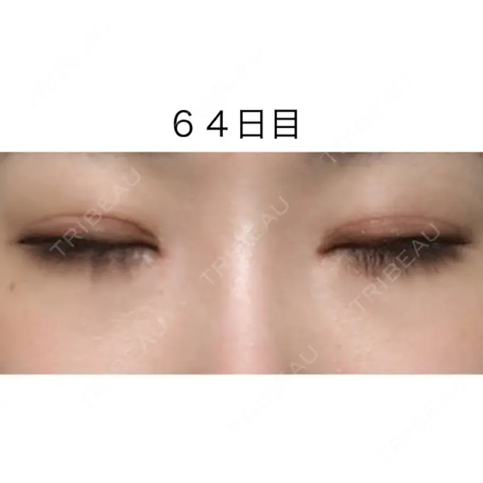 二重切開 / 目頭切開 / 眼瞼下垂（切開） / 目尻切開 / タレ目形成・グラマラスライン（切開） ジュエリー美容外科 DAY 63 メイン用