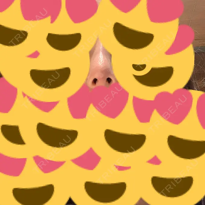 隆鼻術 / プロテーゼ除去 / 鼻修正 十仁美容整形 DAY 16 メイン用