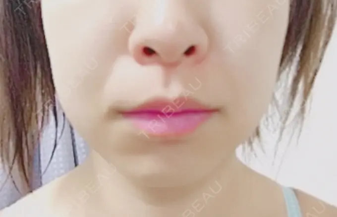 脂肪溶解注射（顔） 新宿美容外科クリニック 新宿院 DAY 3 メイン用