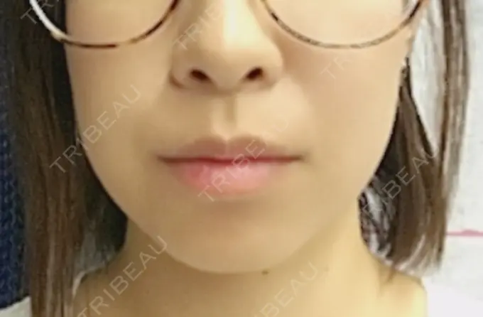 脂肪溶解注射（顔） 新宿美容外科クリニック 新宿院 DAY 3 メイン用