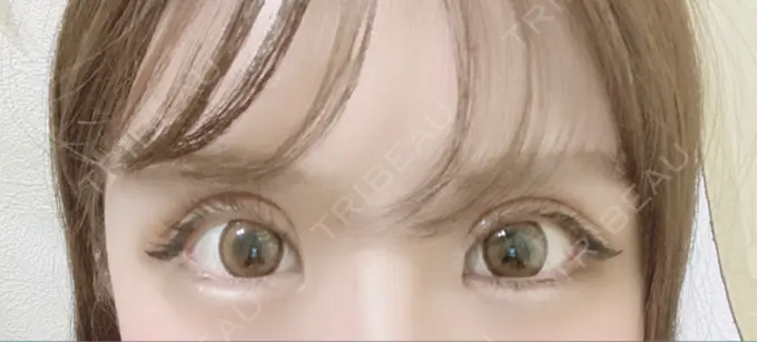 二重切開 / 目元修正 心斎橋コムロ美容外科クリニック DAY 118 メイン用