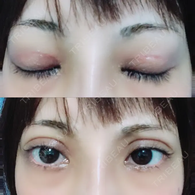 二重切開 / ヒアルロン酸注入（鼻） 品川スキンクリニック沖縄院 DAY 20 メイン用