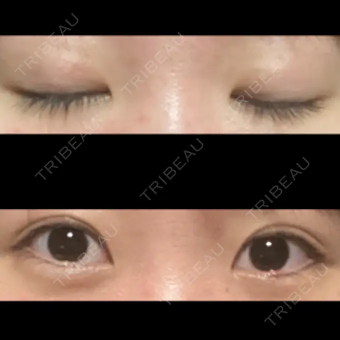 二重埋没 東京形成美容外科 船橋院 DAY 112 メイン用