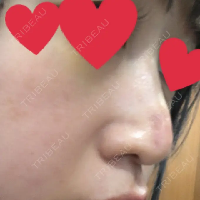 小鼻縮小（切開） / 鼻尖縮小 グレーススキンクリニック DAY 5 メイン用