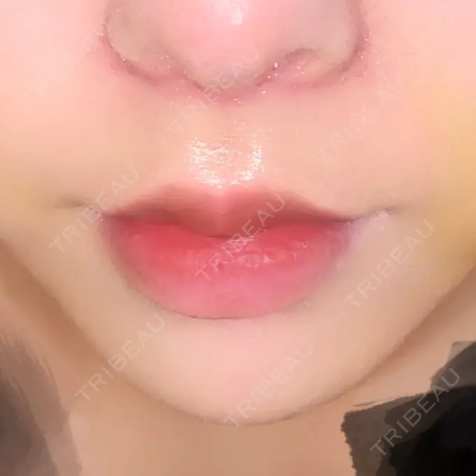 人中短縮 / PRP皮膚再生療法 BIANCA銀座 DAY 7 メイン用