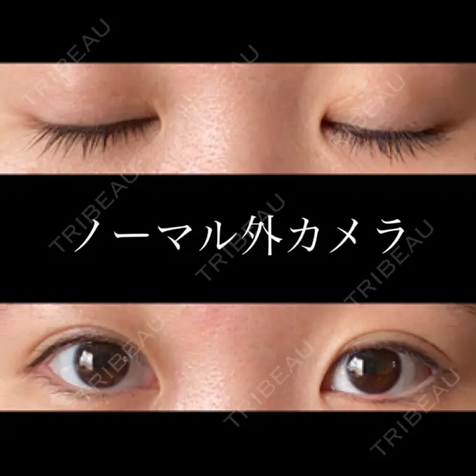 二重埋没 東京形成美容外科 船橋院 DAY 113 メイン用