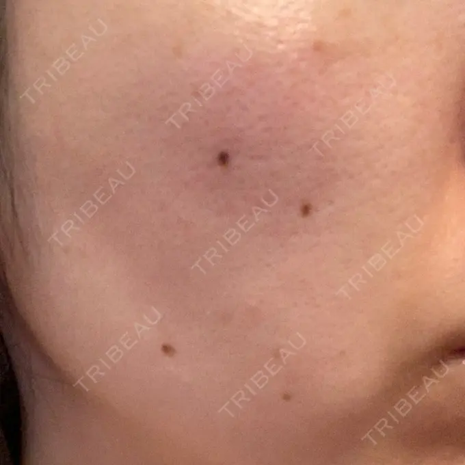 シミ取りレーザー Dual Clinic KOBE DAY 14 メイン用