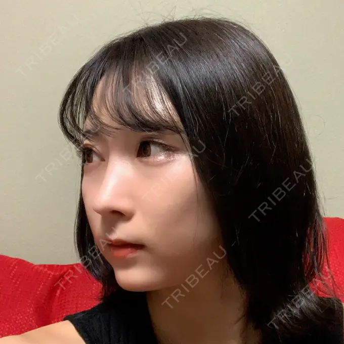 鼻尖形成（切開） / 小鼻縮小（切開） / 糸リフト / あごプロテーゼ / 骨削り（頬） / 脂肪吸引（顔） / 軟骨移植 ウォンジン（Wonjin）整形外科 DAY 308 メイン用