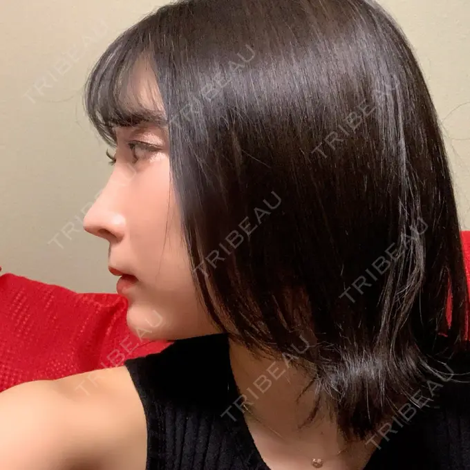 鼻尖形成（切開） / 小鼻縮小（切開） / 糸リフト / あごプロテーゼ / 骨削り（頬） / 脂肪吸引（顔） / 軟骨移植 ウォンジン（Wonjin）整形外科 DAY 308 メイン用