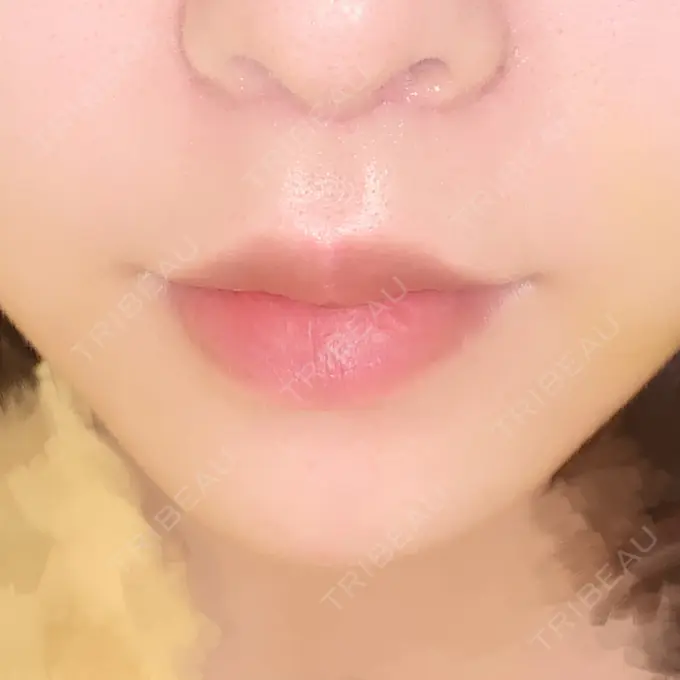 人中短縮 / PRP皮膚再生療法 BIANCA銀座 DAY 9 メイン用