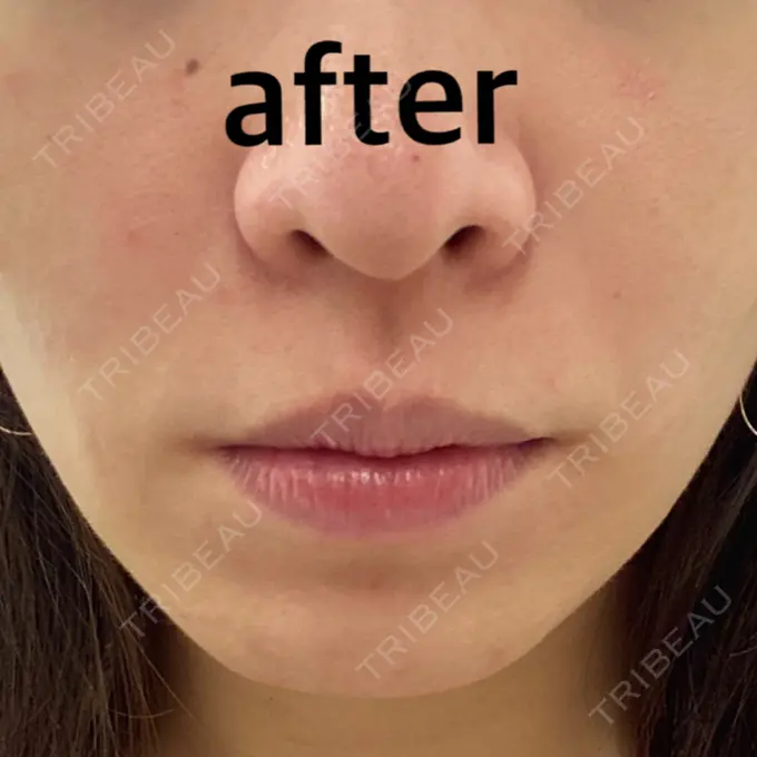 ボトックス（エラ・小顔） / ハイフ（顔） TCB東京中央美容外科 中野院 DAY 0 メイン用