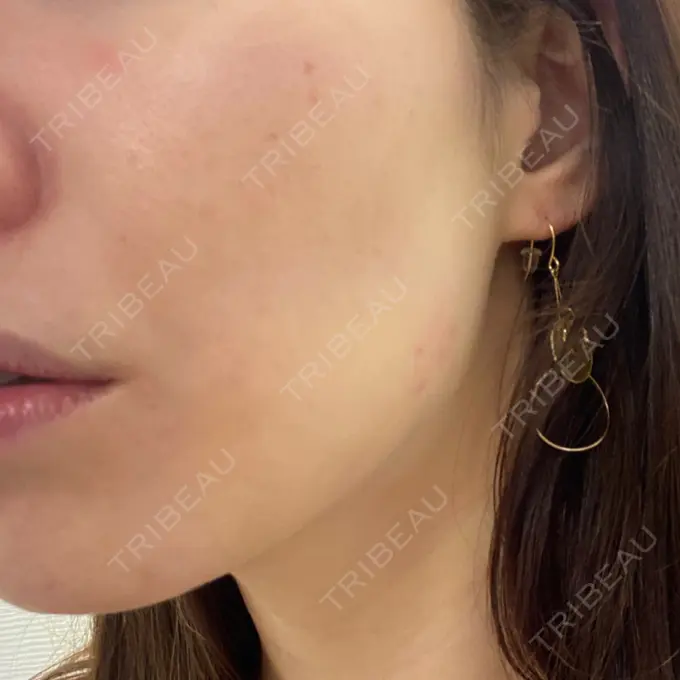 ボトックス（エラ・小顔） / ハイフ（顔） TCB東京中央美容外科 中野院 DAY 0 メイン用