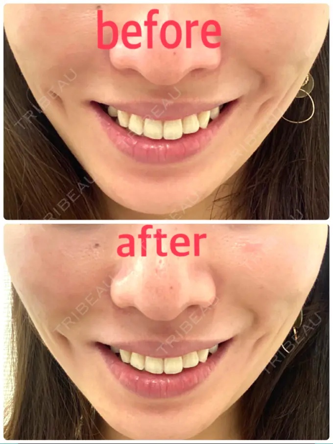 ボトックス（エラ・小顔） / ハイフ（顔） TCB東京中央美容外科 中野院 DAY 0 メイン用