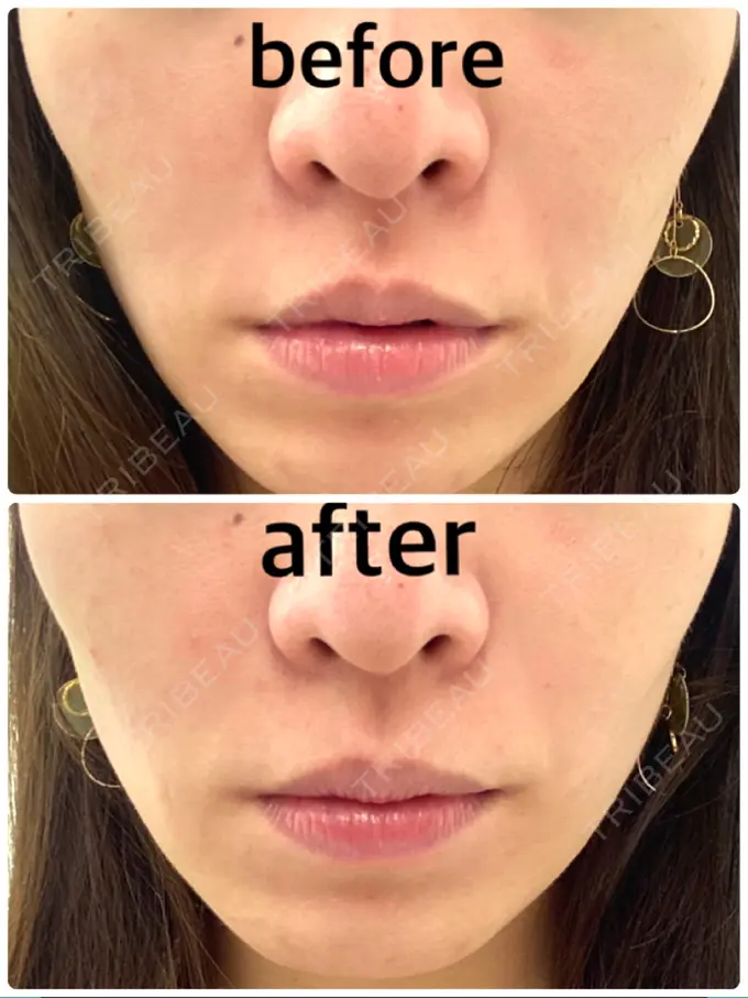 ボトックス（エラ・小顔） / ハイフ（顔） TCB東京中央美容外科 中野院 DAY 0 メイン用