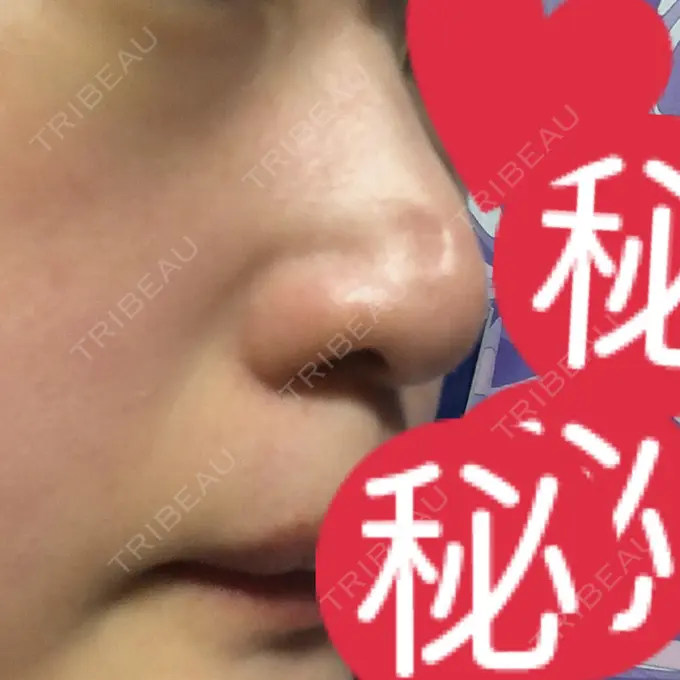 小鼻縮小（切開） / 鼻尖縮小 グレーススキンクリニック DAY 7 メイン用