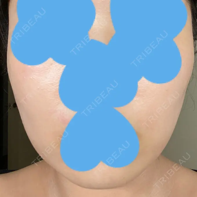 脂肪溶解注射（顔） ビクアスクリニック DAY 16 メイン用