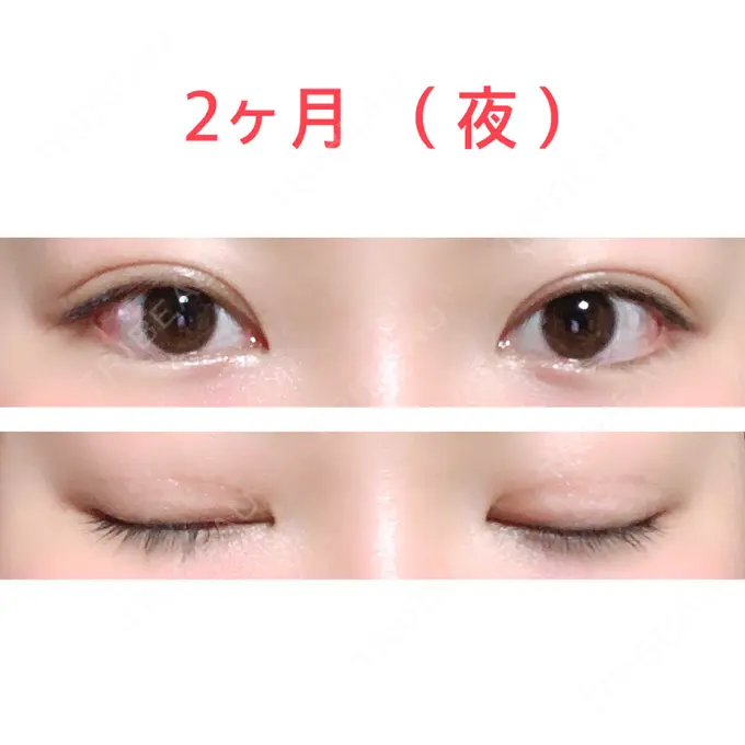 二重切開 水の森美容クリニック 東京新宿院 DAY 61 メイン用