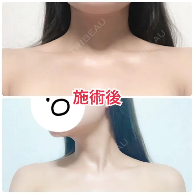 ボトックス（肩） ヴェルトラクリニック 大阪院 DAY 0 メイン用