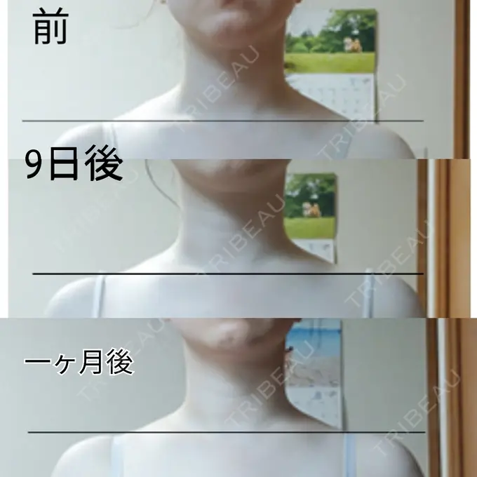 ボトックス（肩） もとび美容外科クリニック 新宿院 AFTER メイン用