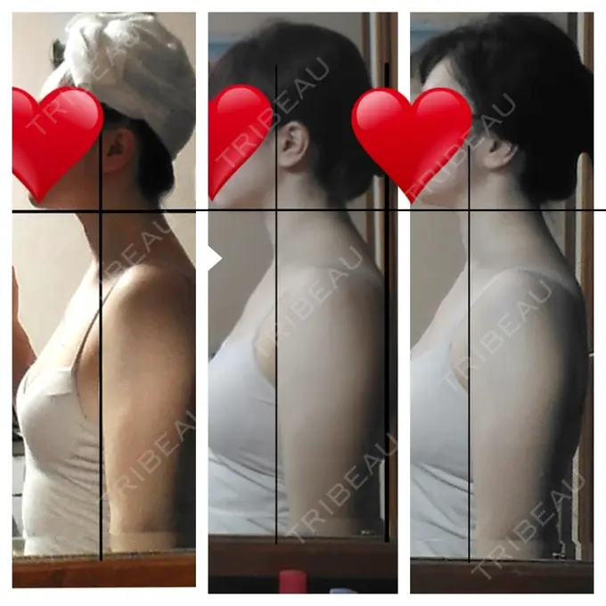 ボトックス（肩） もとび美容外科クリニック 新宿院 DAY 30 メイン用