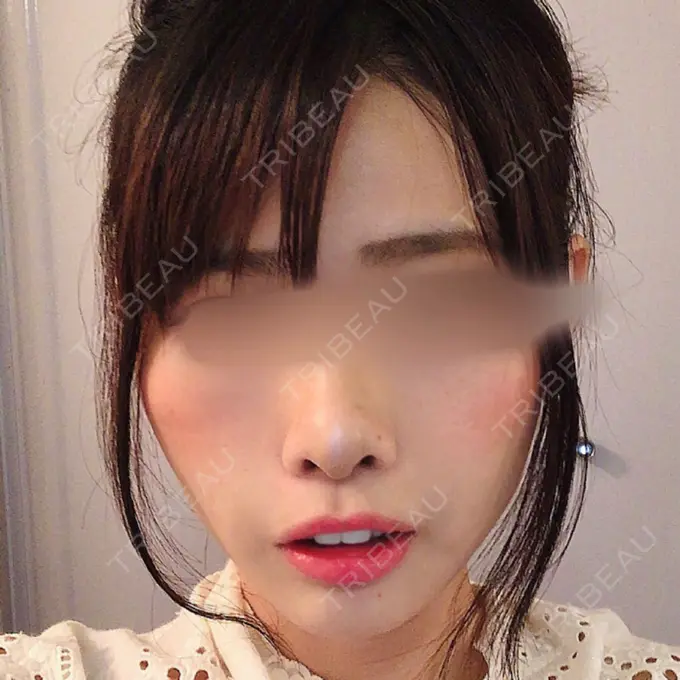 糸リフト / ヒアルロン酸注入（あご） / ボトックス（エラ・小顔） / 脂肪溶解注射（顔） / その他（鼻） 大阪TAクリニック AFTER メイン用