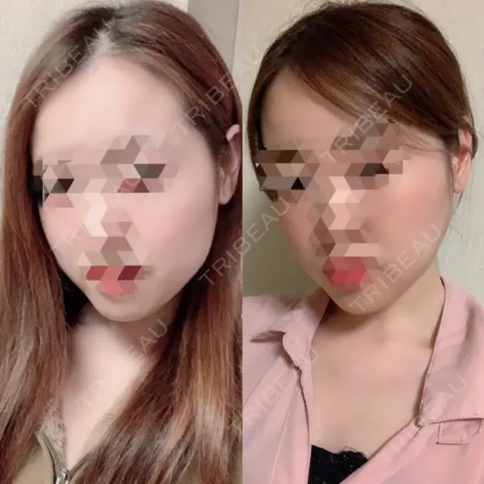 糸リフト / 骨切り（あご） / 骨削り（エラ） RG整形外科（旧リオン整形外科） DAY 185 メイン用