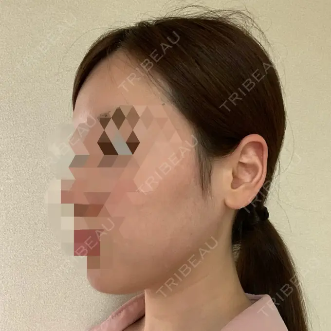 糸リフト / 骨切り（あご） / 骨削り（エラ） RG整形外科（旧リオン整形外科） DAY 185 メイン用