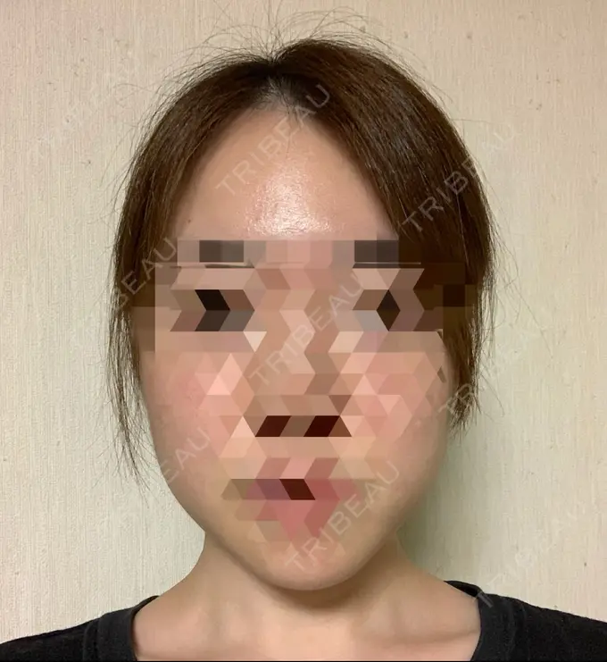 糸リフト / 骨切り（あご） / 骨削り（エラ） RG整形外科（旧リオン整形外科） AFTER メイン用